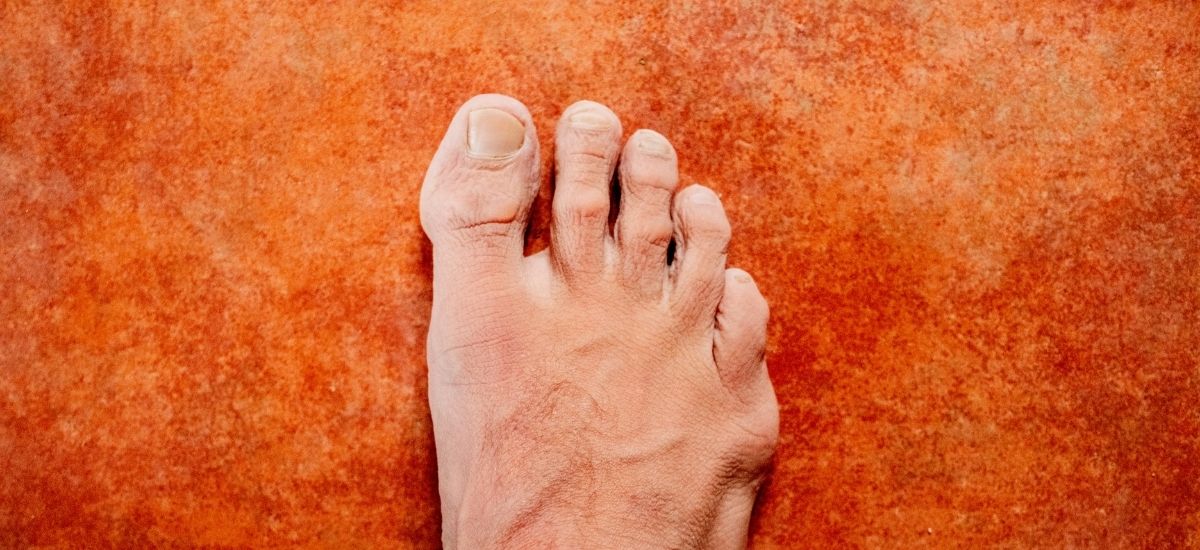 Hallux Rigidus Treatment
